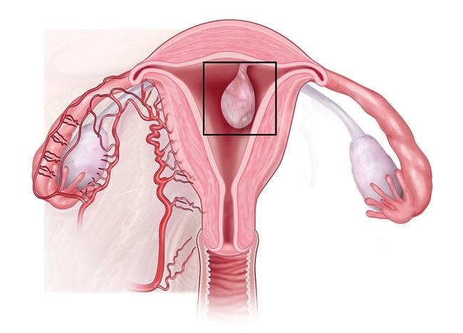 Как выглядит полип эндометрия