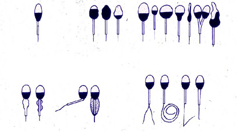 Варианты тератоспермии Варианты тератоспермии