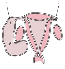 Гидросальпинкс