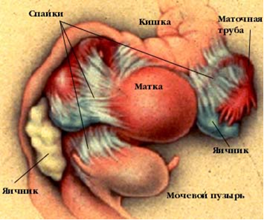 Спайки в малом тазу