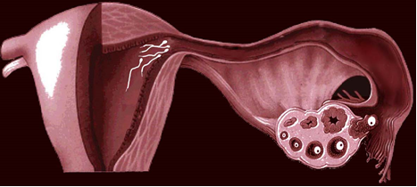 Непроходимость маточной трубы